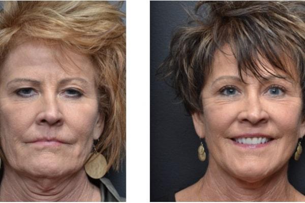 Utah Eyelid & Facial Plastic Surgery facelift result — Millcreek, UT