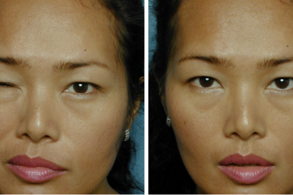 Utah Eyelid & Facial Plastic Surgery result — Millcreek, UT