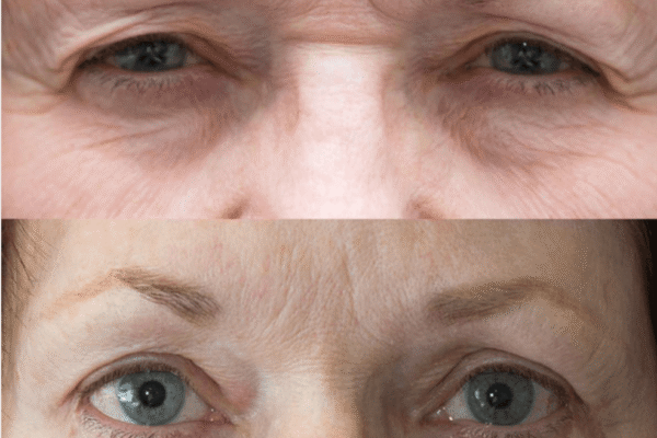 Utah Eyelid & Facial Plastic Surgery facelift result — Millcreek, UT