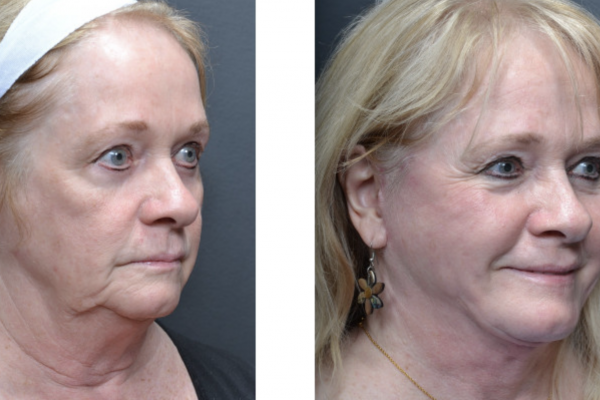Facelift result at Utah Eyelid & Facial Plastic Surgery in Millcreek, UT