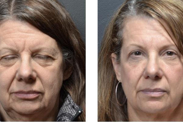 Utah Eyelid & Facial Plastic Surgery eyelid lift result — Millcreek, UT