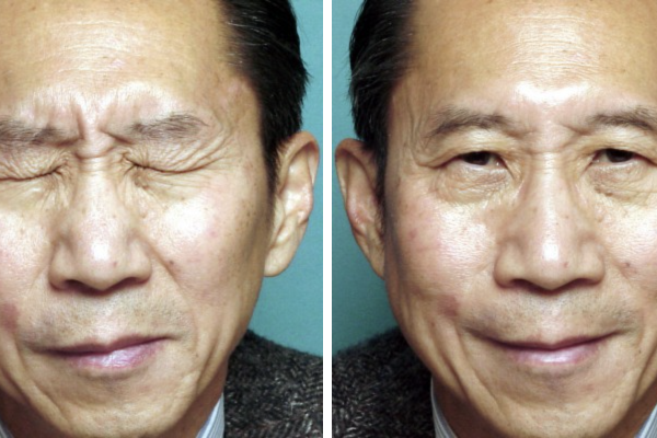 Utah Eyelid & Facial Plastic Surgery result — Millcreek, UT