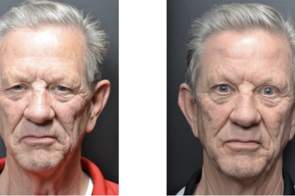 Utah Eyelid & Facial Plastic Surgery result — Millcreek, UT
