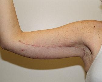 Feel Beautiful Plastic Surgery San Diego, Steve Laverson MD arm lift after — Rancho Santa Fe, CA