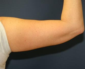 Feel Beautiful Plastic Surgery San Diego, Steve Laverson MD arm lift after — Rancho Santa Fe, CA