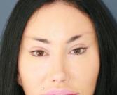 Feel Beautiful Plastic Surgery San Diego, Steve Laverson MD blepharoplasty after — Rancho Santa Fe, CA