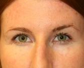 Feel Beautiful Plastic Surgery San Diego, Steve Laverson MD blepharoplasty after — Rancho Santa Fe, CA