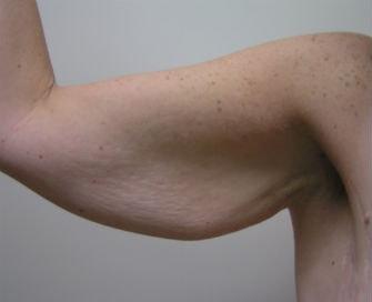 Arm Lift before at Feel Beautiful Plastic Surgery San Diego, Steve Laverson MD in Rancho Santa Fe, CA