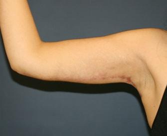 Feel Beautiful Plastic Surgery San Diego, Steve Laverson MD arm lift after — Rancho Santa Fe, CA