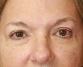 Feel Beautiful Plastic Surgery San Diego, Steve Laverson MD blepharoplasty after — Rancho Santa Fe, CA