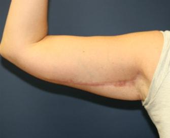 Feel Beautiful Plastic Surgery San Diego, Steve Laverson MD arm lift after — Rancho Santa Fe, CA
