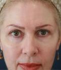Feel Beautiful Plastic Surgery San Diego, Steve Laverson MD blepharoplasty after — Rancho Santa Fe, CA