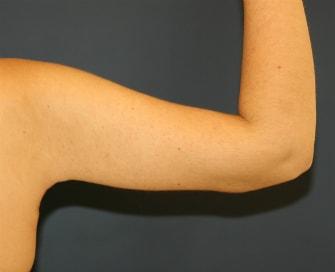 Feel Beautiful Plastic Surgery San Diego, Steve Laverson MD arm lift after — Rancho Santa Fe, CA