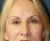 Feel Beautiful Plastic Surgery San Diego, Steve Laverson MD blepharoplasty after — Rancho Santa Fe, CA