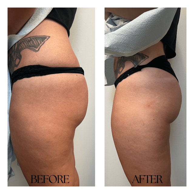 Botox result at New Medical Spa in Glen Allen, VA