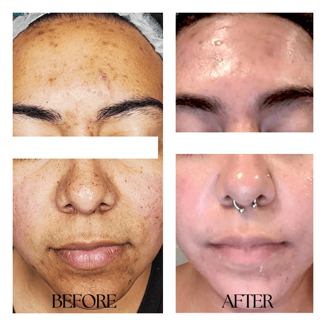 Morpheus8 result at New Medical Spa in Glen Allen, VA