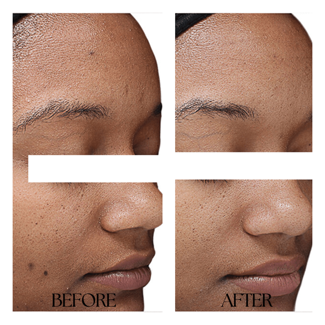 Chemical Peel result at New Medical Spa in Glen Allen, VA