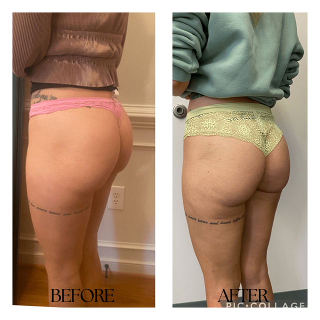 Botox result at New Medical Spa in Glen Allen, VA