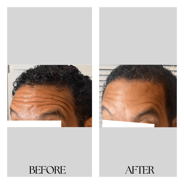 Botox result at New Medical Spa in Glen Allen, VA