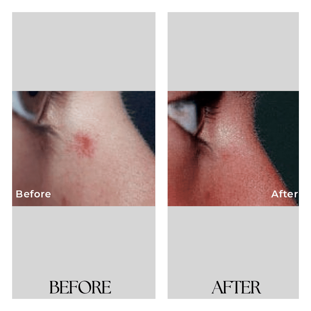 New Medical Spa breast reduction result — Glen Allen, VA