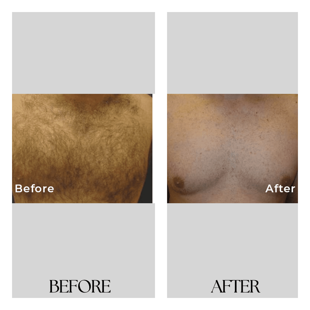 New Medical Spa laser treatment result — Glen Allen, VA