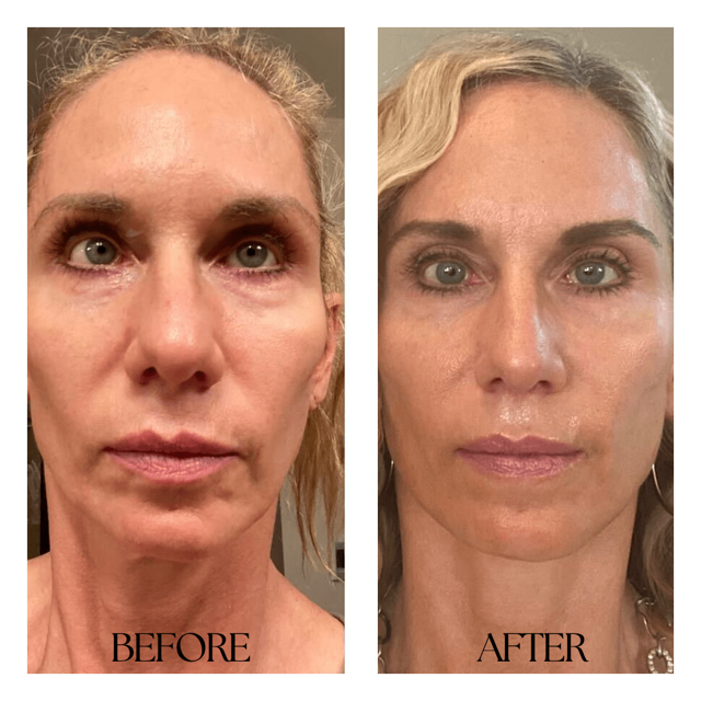 Lip Filler result at New Medical Spa in Glen Allen, VA