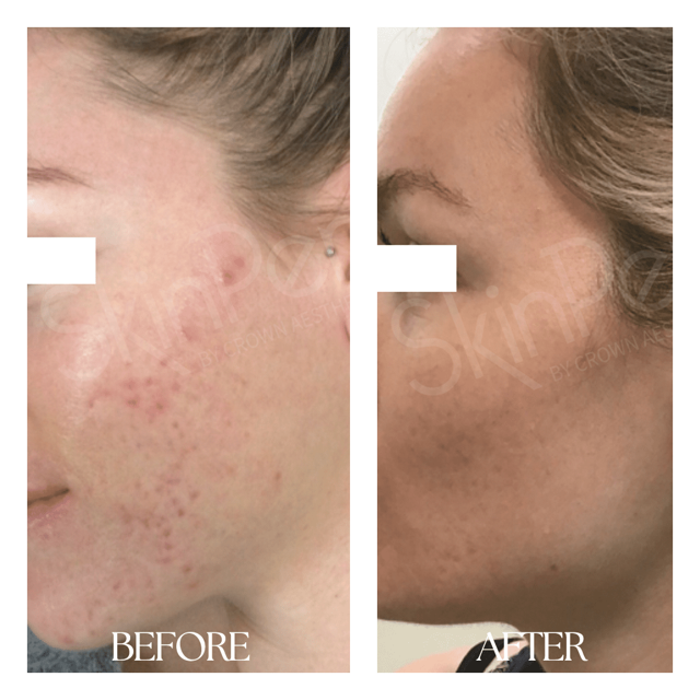 Microneedling result at New Medical Spa in Glen Allen, VA