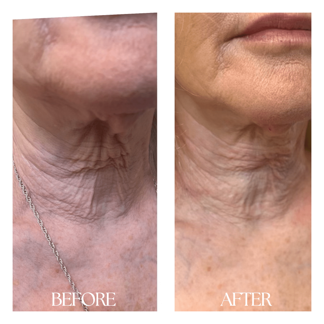New Medical Spa laser treatment result — Glen Allen, VA