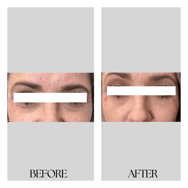 Lip Filler result at New Medical Spa in Glen Allen, VA