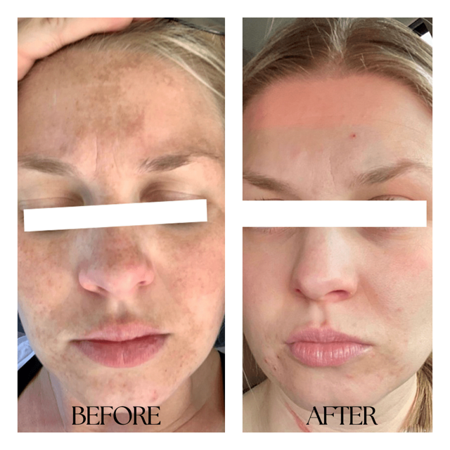 Laser Skin Resurfacing result at New Medical Spa in Glen Allen, VA