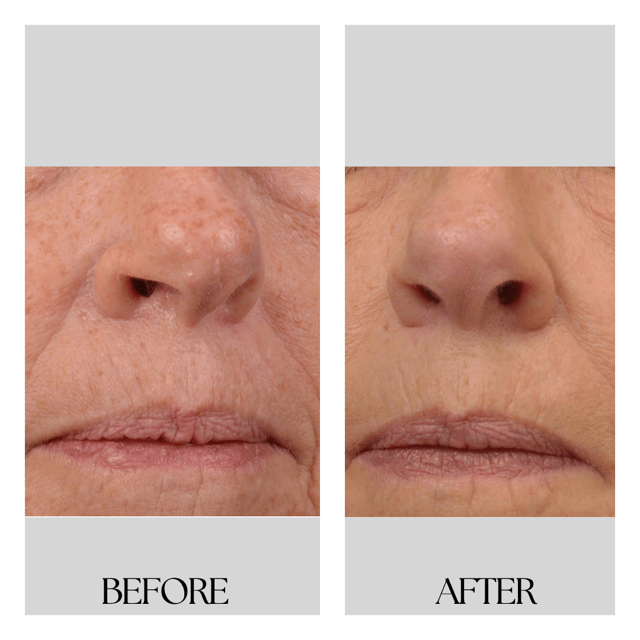 Laser Skin Resurfacing result at New Medical Spa in Glen Allen, VA