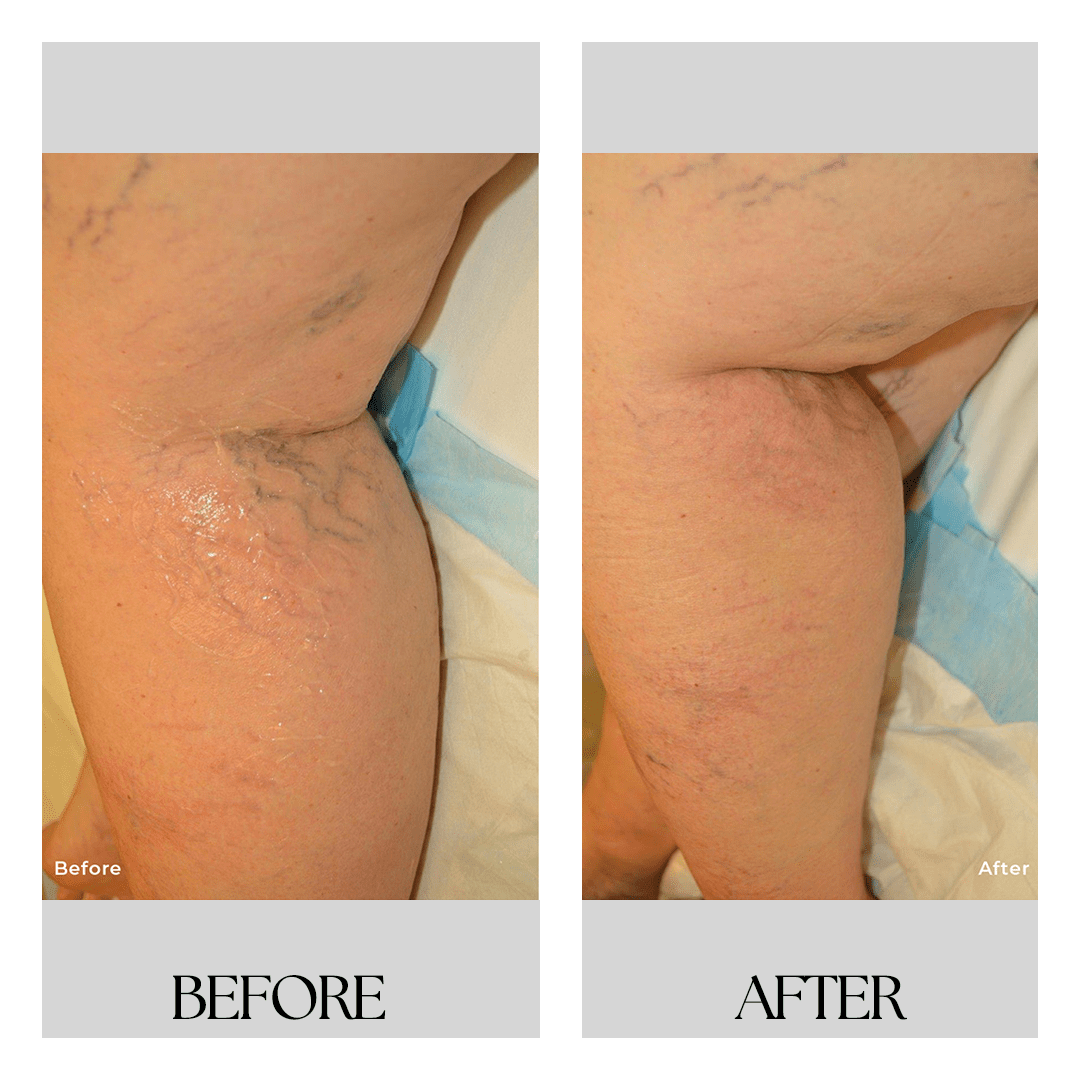 New Medical Spa breast reduction result — Glen Allen, VA