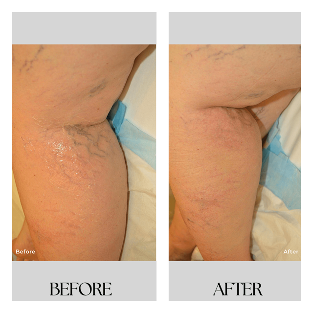 Breast Reduction result at New Medical Spa in Glen Allen, VA