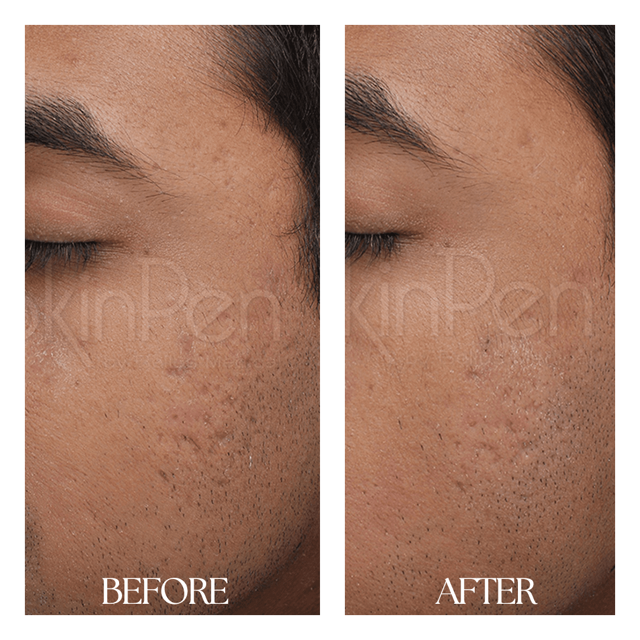 Microneedling result at New Medical Spa in Glen Allen, VA