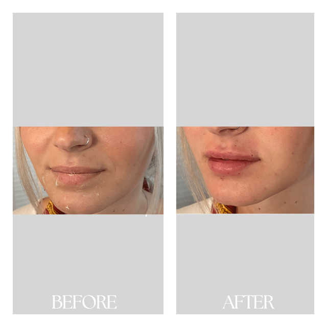 Lip Filler result at New Medical Spa in Glen Allen, VA
