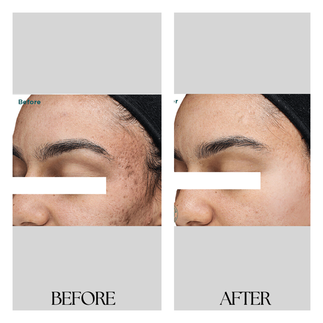 Morpheus8 result at New Medical Spa in Glen Allen, VA