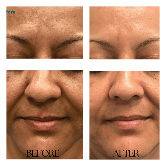 Morpheus8 result at New Medical Spa in Glen Allen, VA