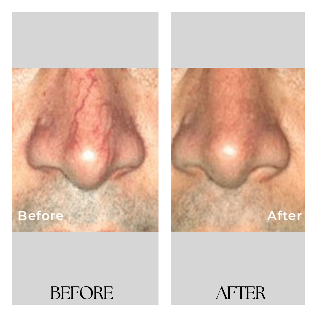 New Medical Spa breast reduction result — Glen Allen, VA
