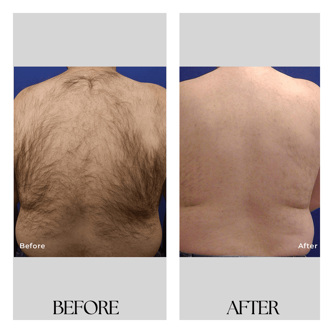 New Medical Spa laser treatment result — Glen Allen, VA