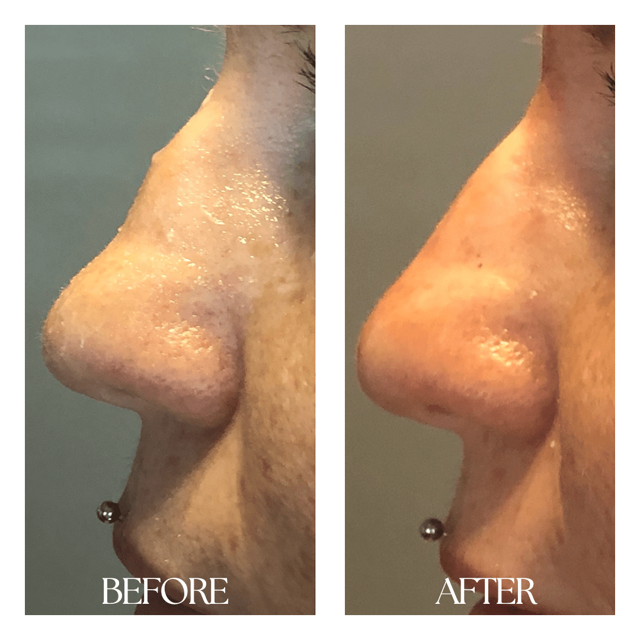 Lip Filler result at New Medical Spa in Glen Allen, VA