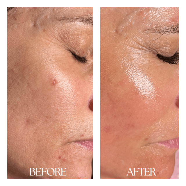 Microneedling result at New Medical Spa in Glen Allen, VA