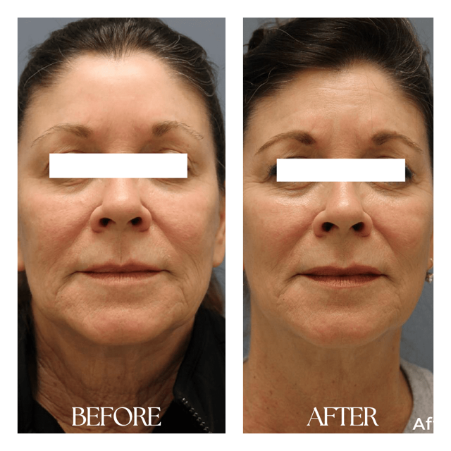 Mini Facelift result at New Medical Spa in Glen Allen, VA