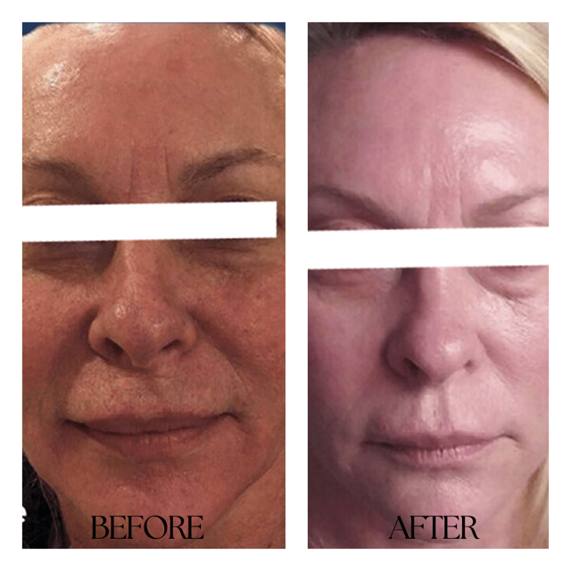 Laser Skin Resurfacing result at New Medical Spa in Glen Allen, VA