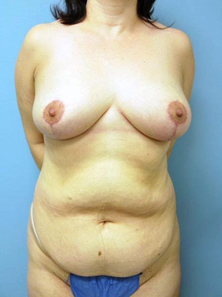 Aldona J. Spiegel, MD breast reduction after — Houston, TX