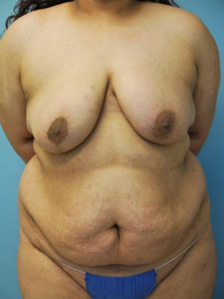 Aldona J. Spiegel, MD breast reduction after — Houston, TX