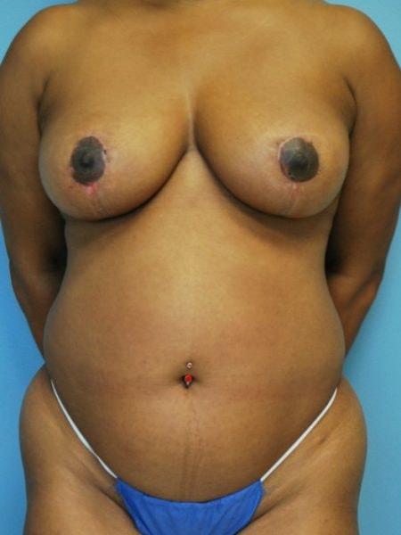 Aldona J. Spiegel, MD breast reduction after — Houston, TX