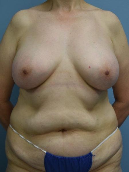Aldona J. Spiegel, MD breast augmentation after — Houston, TX