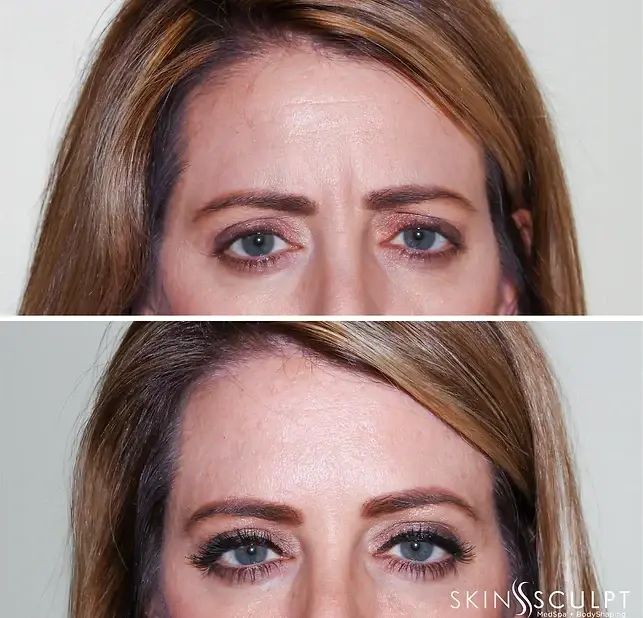 SkinSculpt MedSpa + BodyShaping botox result — South Ogden, UT