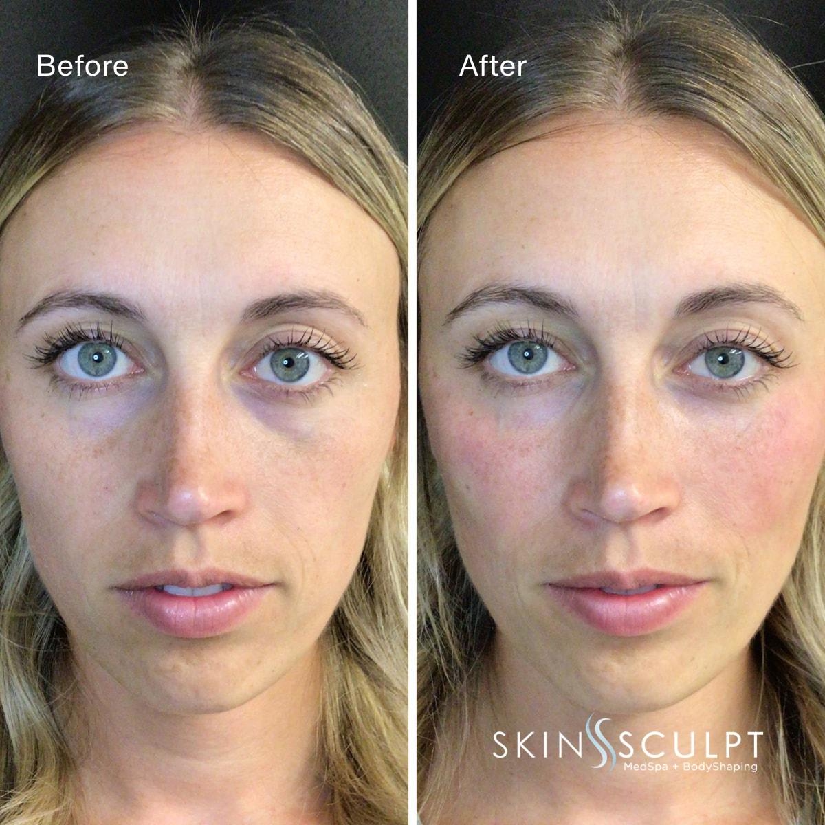SkinSculpt MedSpa + BodyShaping under-eye filler result — South Ogden, UT