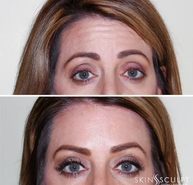 SkinSculpt MedSpa + BodyShaping botox result — South Ogden, UT